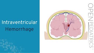 Intraventricular Hemorrhage by A Hansen  OPENPediatrics [upl. by Ecidnac505]