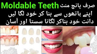 Moldable Teeth  Broken Tooth  moldable false teeth how to use  dant ka dard ka fori ilaj [upl. by Houlberg]