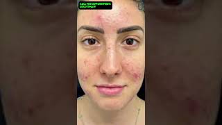 Powerful Acne Package for Acne Treatment [upl. by Ronal]