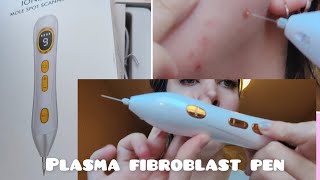 plasma fibroblast pen  alternative to Dermavel  review [upl. by Ahsirtak]