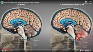 Chiari Malformation Type 1  Symptoms that you may have Chiari Malformation Over Fifty [upl. by Irotal]