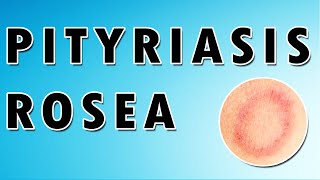 Pityriasis Rosea Symptoms Treatment and Causes [upl. by Llehcear]