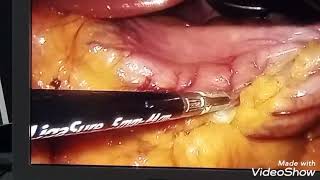 Laparoscopic sleeve gastrectomy for morbid obesity at Expert Alliance hospital kano zulaih [upl. by Ennybor]