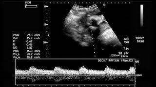 8 weeks fetal heart rate  ultrasound [upl. by Eyanaj]