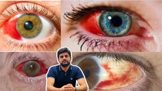 Subconjunctival hemorrhage eye blood education optometry drhashimjabbar subcribemychannel [upl. by Ennoira]