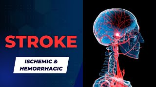 Ischemic and Hemorrhagic Strokes Signs Symptoms and Treatment [upl. by Einnaf]