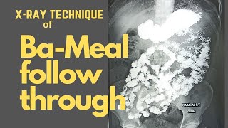 Technique of Barium meal follow throughEp48  BaMeal Stomach amp Duodenum [upl. by Nosniv661]