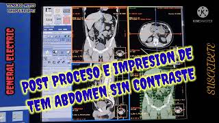 POST PROCESO E IMPRESION DE TOMOGRAFIA DE ABDOMEN SIN CONTRASTE [upl. by Sivrad]