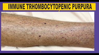 ITP  Immune Thrombocytopenic Purpura [upl. by Rengia132]