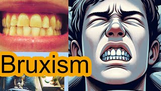 Teeth Grinding in Kids Bruxism [upl. by Wohlen]