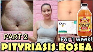 PITYRIASIS ROSEA WHAT’S MY STORY PHILIPPINES [upl. by Lyrehs579]