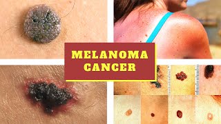 Melanoma Symptoms  Causes Pictures Stages Signs and Symptoms of Melanoma Skin Cancer Tumor [upl. by Weight188]