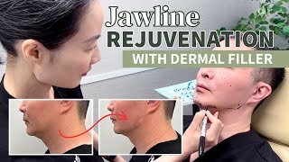 Revolutionize Your Jawline with Juvéderm Volux XC [upl. by Pernell]