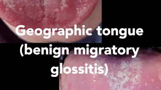 Geographic tongue Also called benign migratory glossitis [upl. by Guenzi752]