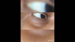 Part 1 3rd Nerve Oculomotor nerve palsy  Ptosis amp MydriasisDrKamaleshTNMediCalLectures [upl. by Alletse]