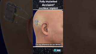 How Does it Work Cochlear Implant Fully Under Skin Undergoing Clinical Trial at Mayo Clinic [upl. by Gerda]