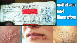 Acivir 200 DT Tablet  Aciclovir 200mg Tablet  Acivir 200mg DT Tablet मुंह के ऊपर छाले बदन पे छाले [upl. by Immak]