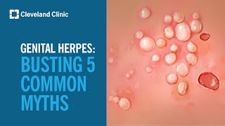 Busting 5 Myths About Genital Herpes [upl. by Gnilyarg560]