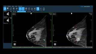 Koning Clinical Case Review Invasive Lobular Carcinoma [upl. by Kasper884]