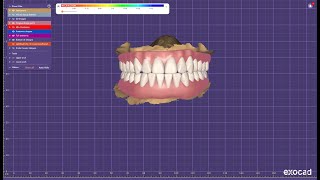 Upper amp lower full mouth designing in Exocad for durable prosthesis [upl. by Aoniak]