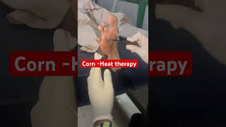 Corn treatment कदरcorn viralshorts trending ​drkgsharma [upl. by Anihc368]