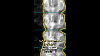 Opportunistic Bone Mineral Density Measurement Using PCD CT Spectral Localizer Images [upl. by Bekelja]