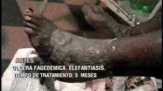 Elefantiasis con ulcera  Elephantiasis with ulcer [upl. by Polito]