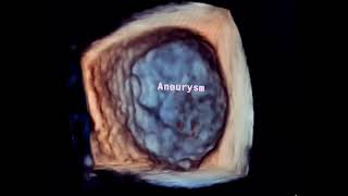 Post coarctation repair Aortic aneurysm  to drahmadmirdamadisi51GE5l547WS4d8ew [upl. by Florian]