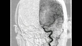 Cerebral aneurisme angiogram [upl. by Odla]