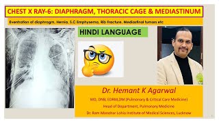 Radiology Chest X Ray6 HINDI Diaphragm Chest wall and MediastinumDr Hemant K Agarwal [upl. by Ticon383]