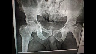 Acetabulum Percutaneous technique  Dr Ramprasad K MSORTHO AIIMS FAOA AUS A1 ORTHOCARE [upl. by Oicafinob]