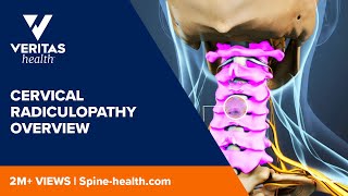 Cervical Radiculopathy Overview [upl. by Bria681]