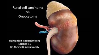 Renal Cell Carcinoma vs Oncocytoma Highlights in Radiology Episode 13 [upl. by Gradeigh]