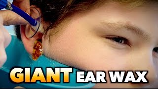 GIANT EAR WAX REMOVAL  Dr Paul [upl. by Iline333]