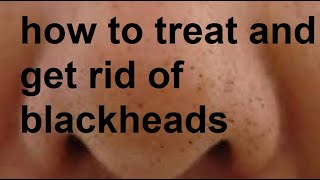 Managing Blackheads Causes and Prevention [upl. by Roberson208]