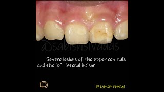 Enamel Hypoplasia Management [upl. by Ahsilad]