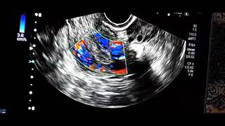 Follicle Tracking on ultrasound TVS scan interesting case do watch and subscribe us [upl. by Hakilam]