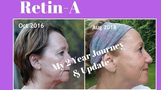 RetinA  My 2 year journey with before and after  Monikas Beauty amp Lifestyle [upl. by Enilesor]