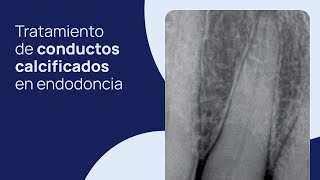 Tratamiento de conductos calcificados en endodoncia cómo instrumentar trucos y consejos personales [upl. by Ange]