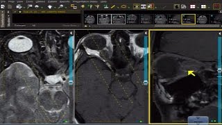 MRI Case Review How To Assess Meningioma of the Optic Nerve Sheath [upl. by Schwab]