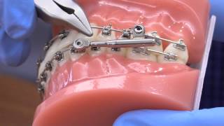 American Orthodontics PowerScope Activation [upl. by Enoitna609]