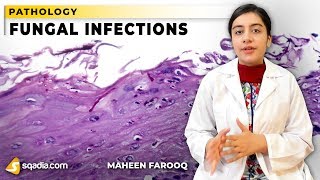 Fungal Infections  Candida  Pathology Video Lectures  VLearning  sqadiacom [upl. by Adihsar]