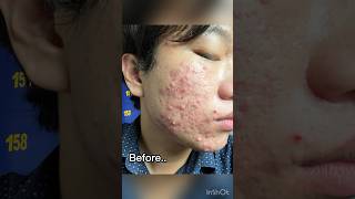 Severe acne before and after isotretinoin 1 year treatment acne isotretinoin jerawat acnescars [upl. by Nagey]