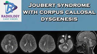 Joubert syndrome with corpus callosal dysgenesis [upl. by Terej908]