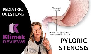 PYLORIC STENOSIS  questions with Dr Sharon [upl. by Mcclenon]