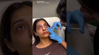 Dermis Clinic  Dark Circles pigmention darkeyes skincareroutine skincare manchester [upl. by Llehsram]