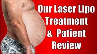 Lipo Laser ilipo Treatment amp Review From a Patient [upl. by Tfat224]