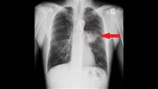 Bronchogenic Carcinoma  Chest X Rays [upl. by Eidissac649]