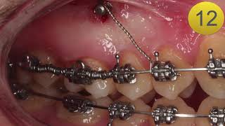 Técnica Distalamiento Molar Minitornillo [upl. by Nowyt359]