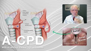 Having Trouble Swallowing Foods and Pills ACPD Can Be Treated with Cricopharyngeal Myotomy [upl. by Marquet716]